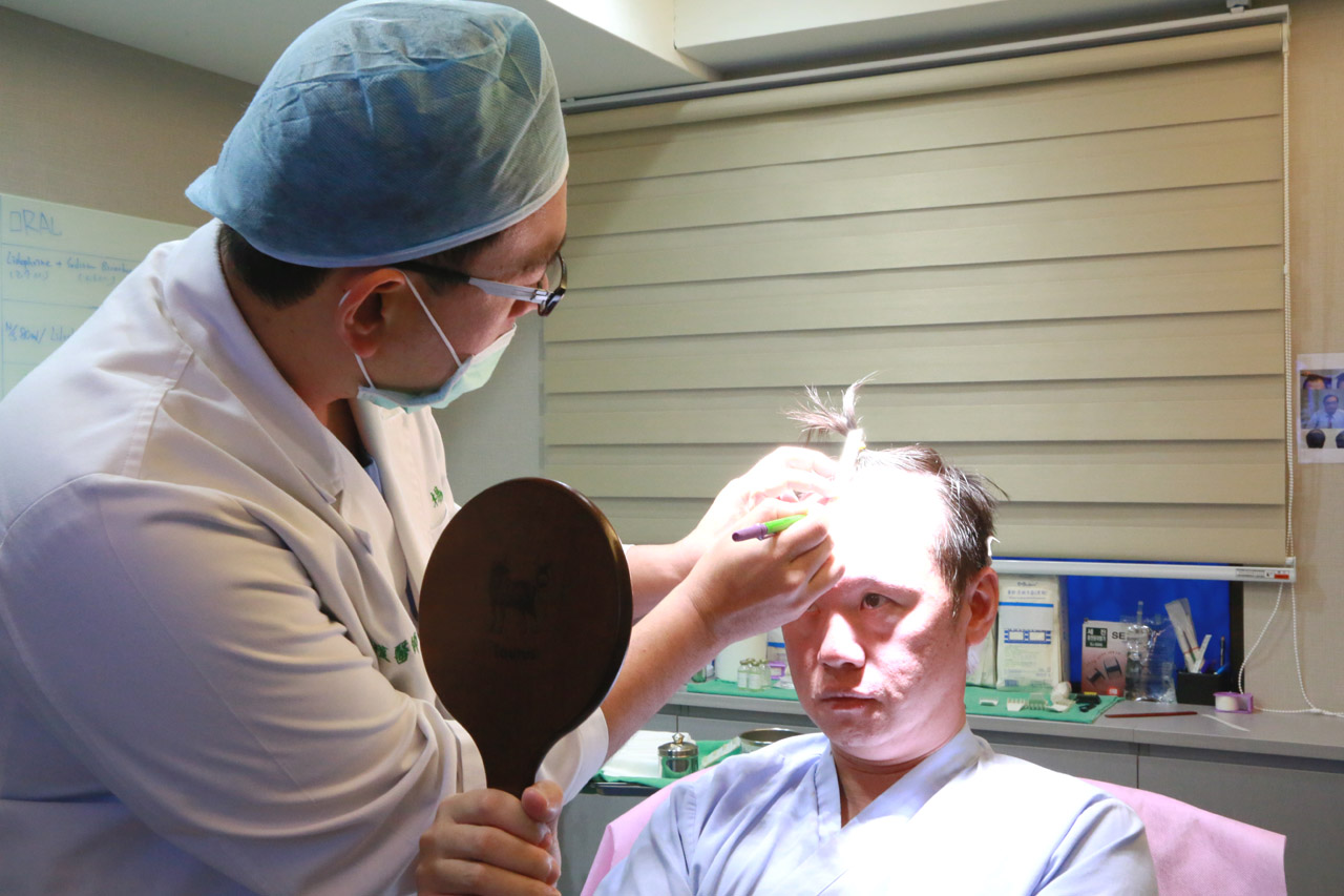 丁元凱,植髮,禿頭,禿髮